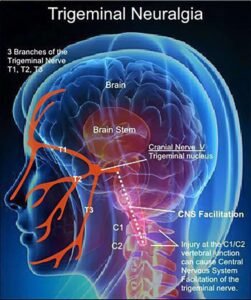 Trigeminal Neuralgia Nerves